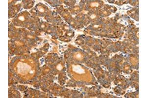 The image on the left is immunohistochemistry of paraffin-embedded Human thyroid cancer tissue using ABIN7192287(SCT Antibody) at dilution 1/40, on the right is treated with synthetic peptide. (Secretin antibody)