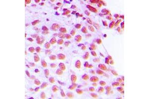 Immunohistochemical analysis of FEN1 staining in human breast cancer formalin fixed paraffin embedded tissue section.