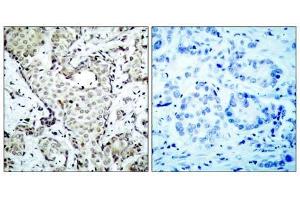 Immunohistochemical analysis of paraffin-embedded human breast carcinoma tissue, using MKK6 (Ab-207) antibody (E021153). (MAP2K6 antibody)