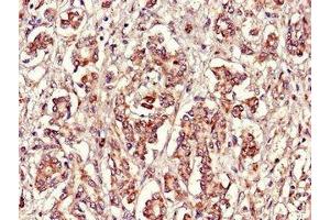 Immunohistochemistry of paraffin-embedded human pancreatic cancer using ABIN7152398 at dilution of 1:100 (FBXL22 antibody  (AA 123-229))