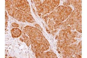IHC-P Image Immunohistochemical analysis of paraffin-embedded SW480 xenograft, using TCP1 beta, antibody at 1:100 dilution. (CCT2 antibody)