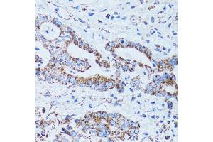 Immunohistochemistry of paraffin-embedded human colon carcinoma using GIP antibody (ABIN5973668) at dilution of 1/100 (40x lens). (GIP antibody)