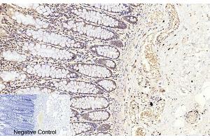 Immunohistochemical analysis of paraffin-embedded human colon tissue. (Caspase 3 p17 (AA 100-180), (Cleaved-Asp175) antibody)