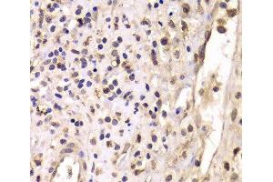 Immunohistochemistry of paraffin-embedded Human breast cancer using HDAC4 Polyclonal Antibody at dilution of 1:100 (40x lens). (HDAC4 antibody)