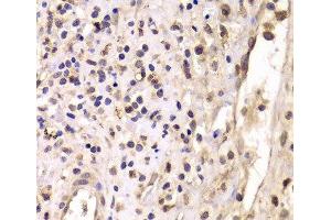 Immunohistochemistry of paraffin-embedded Human breast cancer using HDAC4 Polyclonal Antibody at dilution of 1:100 (40x lens). (HDAC4 antibody)