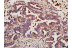 Formalin-fixed and paraffin embedded human lung carcinoma labeled with Rabbit Anti-MSH6 Polyclonal Antibody, Unconjugated 1:200 followed by conjugation to the secondary antibody and DAB staining (MSH6 antibody  (AA 812-910))
