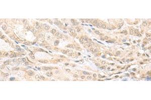 Immunohistochemistry of paraffin-embedded Human thyroid cancer tissue using EMX1 Polyclonal Antibody at dilution of 1:25(x200)