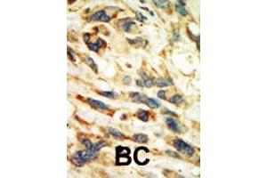 Formalin-fixed and paraffin-embedded human cancer tissue reacted with the primary antibody, which was peroxidase-conjugated to the secondary antibody, followed by AEC staining. (SGK2 antibody  (N-Term))