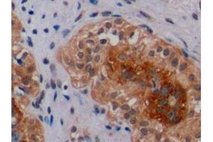 Detection of ErbB2 in Human Breast Cancer Tissue using Polyclonal Antibody to Receptor Tyrosine Protein Kinase erbB-2 (ErbB2) (ErbB2/Her2 antibody  (AA 23-372))