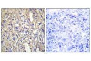 Immunohistochemistry analysis of paraffin-embedded human liver carcinoma tissue using LAMB1 antibody. (Laminin beta 1 antibody  (C-Term))