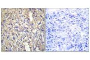 Immunohistochemistry analysis of paraffin-embedded human liver carcinoma tissue using LAMB1 antibody.