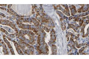 ABIN6267163 at 1/100 staining Human thyroid cancer tissue by IHC-P. (DLG2 antibody  (pTyr340))
