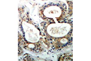 Immunohistochemistry of paraffin-embedded human breast carcinoma using Phospho-PTPN11-Y542 antibody (ABIN2987776). (PTPN11 antibody  (pTyr542))