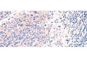 Immunohistochemistry of paraffin-embedded Human cervical cancer tissue using ESM1 Polyclonal Antibody at dilution of 1:50(x200) (ESM1 antibody)