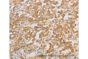 Immunohistochemistry of Human colon cancer using ZWINT Polyclonal Antibody at dilution of 1:50 (ZWINT antibody)