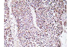 Immunohistochemical analysis of paraffin-embedded human liver carcinoma tissue using GDF9 polyclonal antibody .