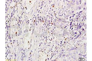 Formalin-fixed and human glioma tissue labeled with Anti-MSR1/CD204 Polyclonal Antibody, Unconjugated (ABIN872905) at 1:200 followed by conjugation to the secondary antibody and DAB staining