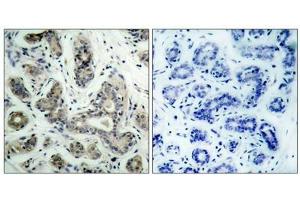 Immunohistochemical analysis of paraffin-embedded human breast carcinoma tissue using BAD(Phospho-Ser136) Antibody(left) or the same antibody preincubated with blocking peptide(right). (BAD antibody  (pSer136))