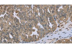 Immunohistochemistry of paraffin-embedded Human ovarian cancer tissue using DCTN4 Polyclonal Antibody at dilution 1:50