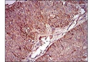 Immunohistochemical analysis of paraffin-embedded ovarian cancer tissues using mSplunc2 mouse mAb with DAB staining.