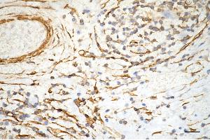 Immunohistochemistry was performed on paraffin-embedded human sigmoid colon carcinoma using alpha smooth muscle actin antibody (ABIN7797465), 1:200). (Recombinant Smooth Muscle Actin antibody)