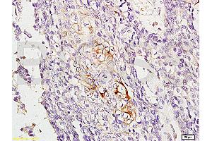 Formalin-fixed and paraffin embedded human esophageal carcinoma labeled with Anti-RAB8 Polyclonal Antibody, Unconjugated (ABIN715316) at 1:200, followed by conjugation to the secondary antibody and DAB staining (RAB8A antibody  (AA 101-207))