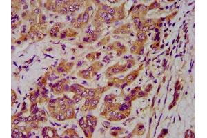 IHC image of ABIN7157412 diluted at 1:400 and staining in paraffin-embedded human liver cancer performed on a Leica BondTM system. (Cytokeratin 1 antibody  (AA 267-438))