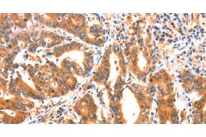 Immunohistochemistry of paraffin-embedded Human gasrtic cancer tissue using AK5 Polyclonal Antibody at dilution 1:60 (Adenylate Kinase 5 antibody)