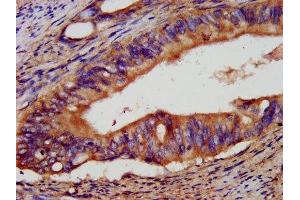 IHC image of ABIN7151921 diluted at 1:400 and staining in paraffin-embedded human colon cancer performed on a Leica BondTM system. (EpCAM antibody  (AA 24-265))
