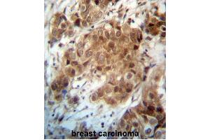 FOXO3 Antibody (N-term) (ABIN657229 and ABIN2846331) immunohistochemistry analysis in formalin fixed and paraffin embedded human breast carcinoma followed by peroxidase conjugation of the secondary antibody and DAB staining. (FOXO3 antibody  (N-Term))