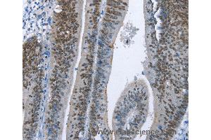 Immunohistochemistry of Human colon cancer using MCM6 Polyclonal Antibody at dilution of 1:60