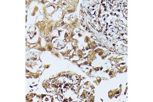 Immunohistochemistry of paraffin-embedded human lung cancer using D antibody (ABIN7266712) at dilution of 1:100 (40x lens).