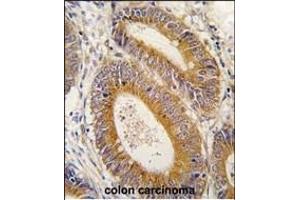 Formalin-fixed and paraffin-embedded human colon carcinoma tissue reacted with YARS2 antibody (N-term) (ABIN6244048 and ABIN6579016) , which was peroxidase-conjugated to the secondary antibody, followed by DAB staining. (YARS2 antibody  (N-Term))