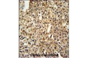 DEN1A Antibody (C-term) (ABIN653873 and ABIN2843124) IHC analysis in formalin fixed and paraffin embedded human cervix carcinoma followed by peroxidase conjugation of the secondary antibody and DAB staining. (DENND1A antibody  (C-Term))