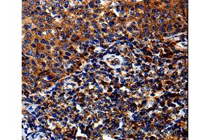 Immunohistochemistry of Human lung cancer using IL13RA1 Polyclonal Antibody at dilution of 1:50 (IL13 Receptor alpha 1 antibody)