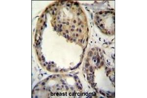 AKT1 antibody (Thr308) (ABIN654500 and ABIN2844231) immunohistochemistry analysis in formalin fixed and paraffin embedded human breast carcinoma followed by peroxidase conjugation of the secondary antibody and DAB staining. (AKT1 antibody  (Thr308))