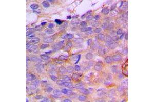 Immunohistochemical analysis of CRABP2 staining in human breast cancer formalin fixed paraffin embedded tissue section. (CRABP2 antibody  (Center))