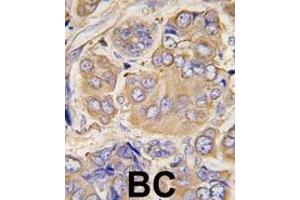 Formalin-fixed and paraffin-embedded human breast carcinoma tissue reacted with HSPB1 Antibody (S78) (ABIN391298 and ABIN2841334) , which was peroxidase-conjugated to the secondary antibody, followed by DAB staining.
