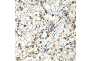 Immunohistochemistry of paraffin-embedded human kidney cancer using ASPSCR1 antibody at dilution of 1:100 (x400 lens).