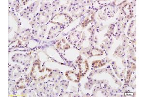 Formalin-fixed and paraffin embedded human colon carcinoma labeled with Anti-PRKD3 Polyclonal Antibody, Unconjugated (ABIN754678) at 1:200 followed by conjugation to the secondary antibody and DAB staining (PRKD3 antibody  (AA 345-550))