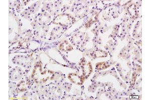 Formalin-fixed and paraffin embedded human colon carcinoma labeled with Anti-PRKD3 Polyclonal Antibody, Unconjugated (ABIN754678) at 1:200 followed by conjugation to the secondary antibody and DAB staining
