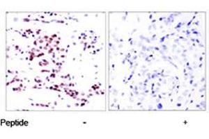 Immunohistochemical analysis of paraffin-embedded human breast carcinoma tissue using STAT5A polyclonal antibody . (STAT5A antibody)
