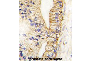 Formalin-fixed and paraffin-embedded human prostate carcinomareacted with CDH7 polyclonal antibody , which was peroxidase-conjugated to the secondary antibody, followed by AEC staining. (Cadherin 7 antibody  (N-Term))