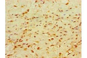 Immunohistochemistry of paraffin-embedded human breast cancer using ABIN7147714 at dilution of 1:100 (CHD1 antibody  (AA 1501-1710))