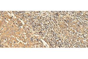 Immunohistochemistry of paraffin-embedded Human cervical cancer tissue using RPS28 Polyclonal Antibody at dilution of 1:30(x200) (RPS28 antibody)