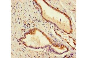 Immunohistochemistry of paraffin-embedded human prostate cancer using ABIN7177995 at dilution of 1:100 (ADCK2 antibody  (AA 200-609))