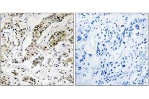 Immunohistochemistry analysis of paraffin-embedded human breast carcinoma, using TCEAL3/5/6 Antibody.