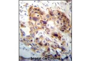 PI15 Antibody (N-term) (ABIN657253 and ABIN2846351) immunohistochemistry analysis in formalin fixed and paraffin embedded human breast carcinoma followed by peroxidase conjugation of the secondary antibody and DAB staining.