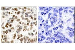 Immunohistochemical analysis of paraffin-embedded human breast carcinoma tissue, using BRCA1 (Ab-1423) antibody (E021234). (BRCA1 antibody)