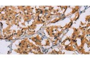 Immunohistochemistry of paraffin-embedded Human thyroid cancer tissue using NRN1 Polyclonal Antibody at dilution of 1:50